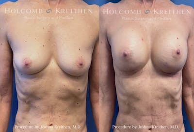 Breast Augmentation Before & After Gallery - Patient 368495 - Image 1