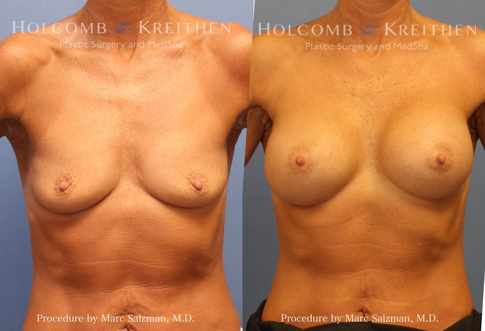 Breast Augmentation Before & After Gallery - Patient 386383 - Image 1