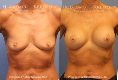 Breast Augmentation Before & After Gallery - Patient 386383 - Image 1