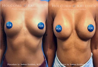 Breast Augmentation Before & After Gallery - Patient 415564 - Image 1