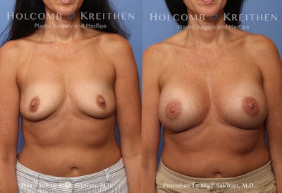 Breast Augmentation Before & After Gallery - Patient 197906 - Image 1