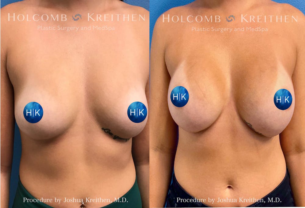 Breast Augmentation Before & After Gallery - Patient 238414 - Image 1