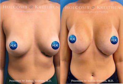 Breast Augmentation Before & After Gallery - Patient 238414 - Image 1