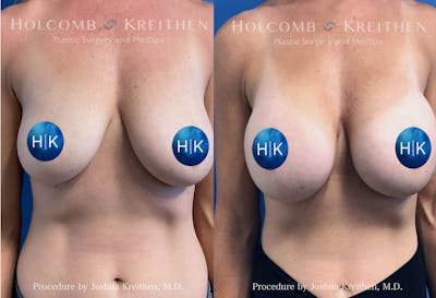 Breast Augmentation Before & After Gallery - Patient 963956 - Image 1
