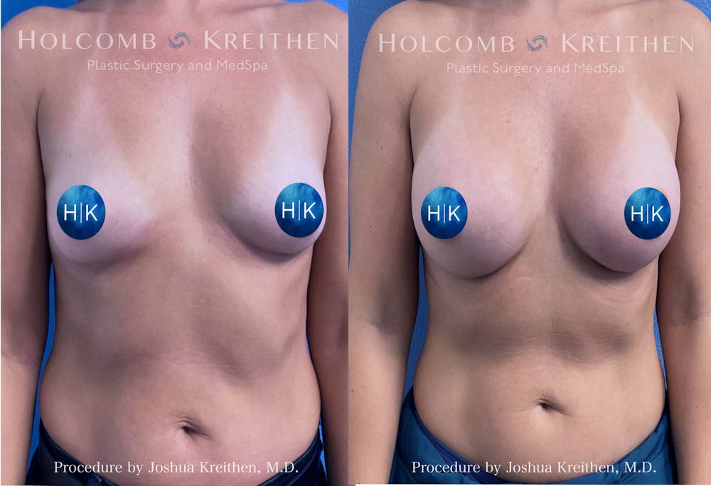 Breast Augmentation Before & After Gallery - Patient 319309 - Image 1