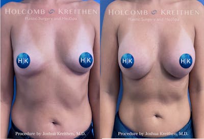 Breast Augmentation Before & After Gallery - Patient 319309 - Image 1