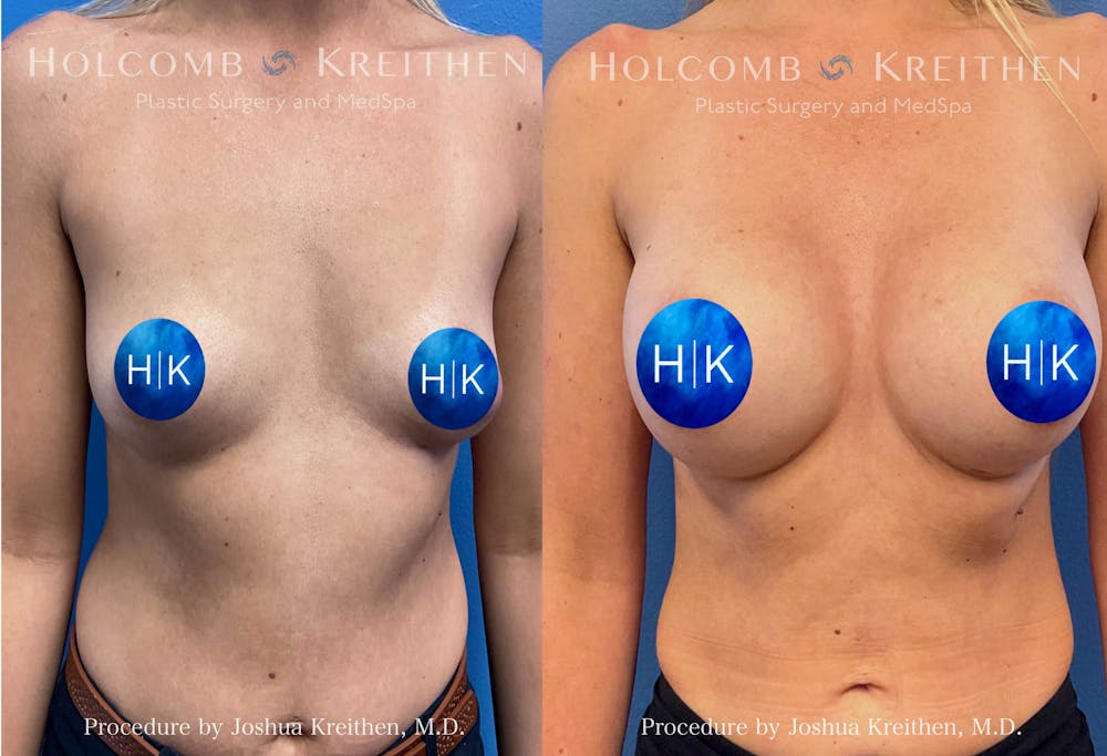 Breast Augmentation Before & After Gallery - Patient 118239 - Image 1