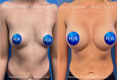 Breast Augmentation Before & After Gallery - Patient 118239 - Image 1
