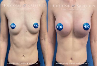 Breast Augmentation Before & After Gallery - Patient 164720 - Image 1