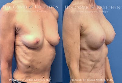 Breast Augmentation Before & After Gallery - Patient 404178 - Image 1