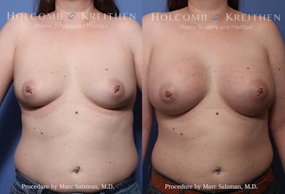 Breast Augmentation Before & After Gallery - Patient 302940 - Image 1
