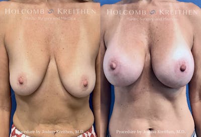 Breast Augmentation Before & After Gallery - Patient 369010 - Image 1