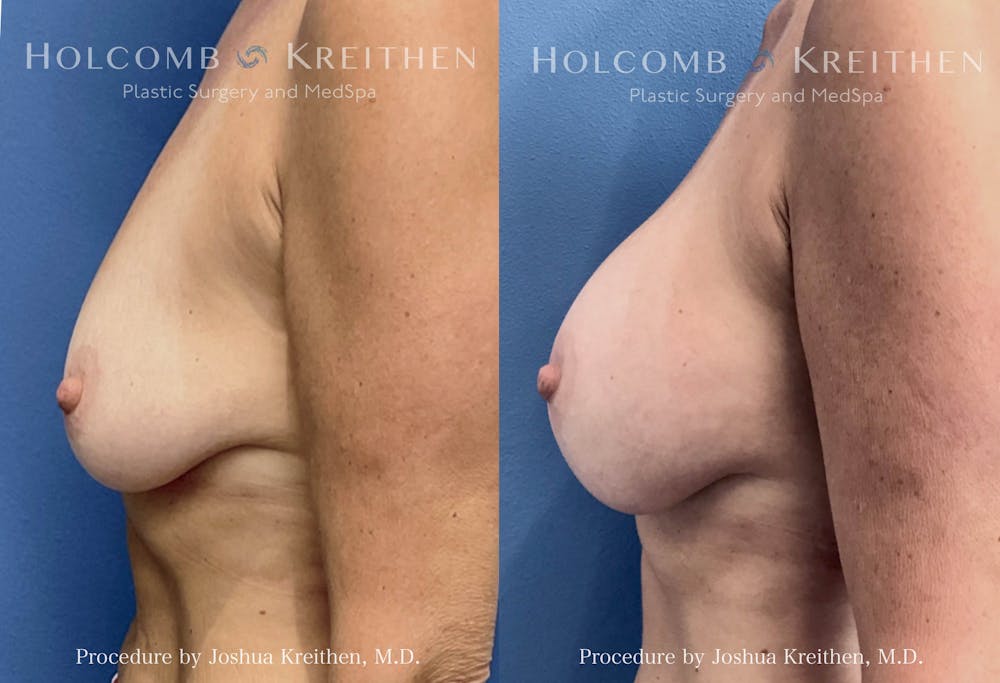 Breast Augmentation Before & After Gallery - Patient 369010 - Image 3
