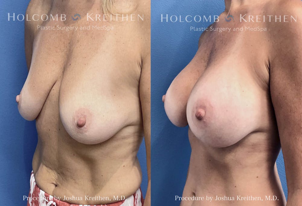 Breast Augmentation Before & After Gallery - Patient 369010 - Image 2