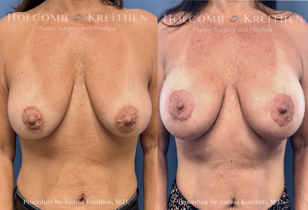 Breast Augmentation Before & After Gallery - Patient 144547 - Image 1