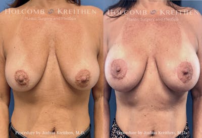 Breast Augmentation Before & After Gallery - Patient 144547 - Image 1