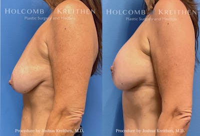 Breast Augmentation Before & After Gallery - Patient 144547 - Image 2