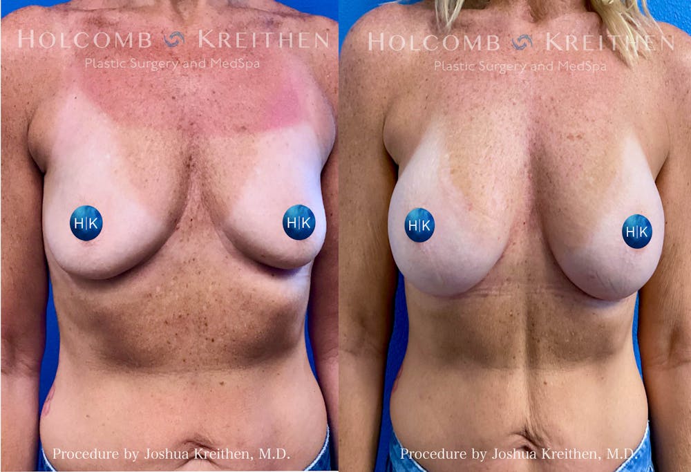 Breast Augmentation Before & After Gallery - Patient 401566 - Image 1