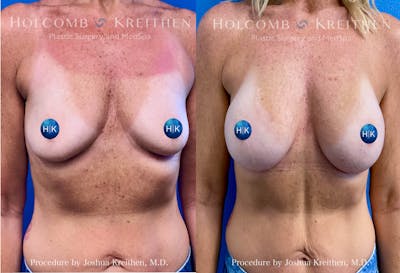Breast Augmentation Before & After Gallery - Patient 401566 - Image 1