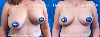 Breast Reduction Before & After Gallery - Patient 369543 - Image 1
