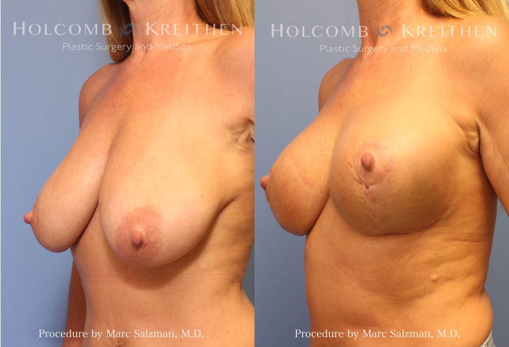 Breast Reduction Before & After Gallery - Patient 399992 - Image 2