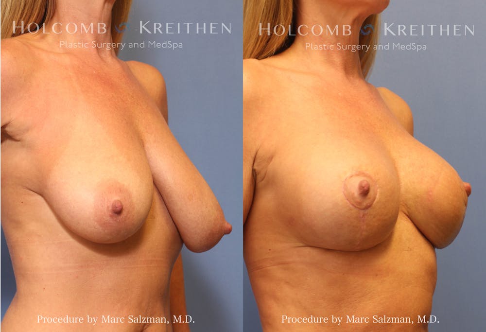 Breast Reduction Before & After Gallery - Patient 399992 - Image 3