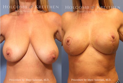 Breast Reduction Before & After Gallery - Patient 399992 - Image 1