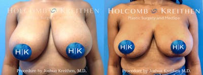 Breast Reduction Before & After Gallery - Patient 270322 - Image 1