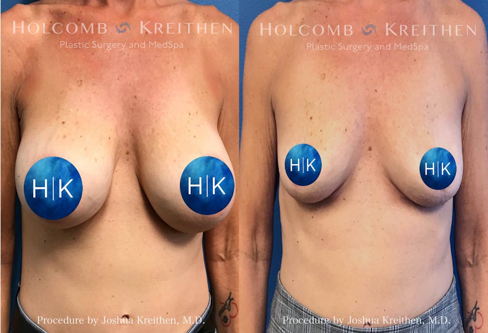 Breast Reduction