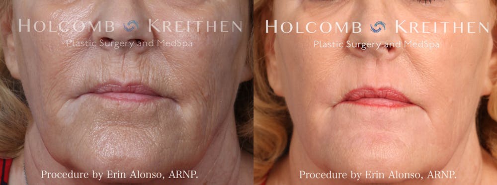 BBL Hero Before & After Gallery - Patient 357714 - Image 1
