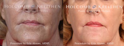 BBL Hero Before & After Gallery - Patient 357714 - Image 1