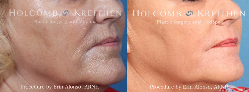 BBL Hero Before & After Gallery - Patient 357714 - Image 2