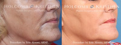 BBL Hero Before & After Gallery - Patient 357714 - Image 2