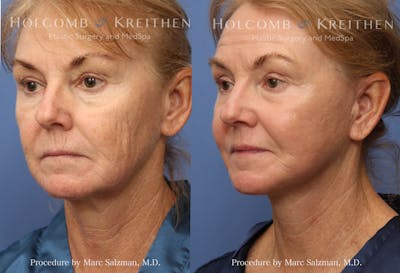 Energy Assisted Face/Neck Lift Before & After Gallery - Patient 271588 - Image 1