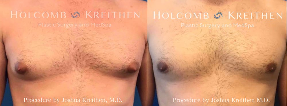 Gynecomastia Before & After Gallery - Patient 197461 - Image 1