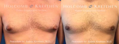 Gynecomastia Before & After Gallery - Patient 197461 - Image 1