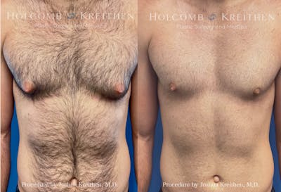 Gynecomastia Before & After Gallery - Patient 225694 - Image 1