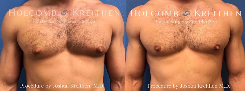 Gynecomastia Before & After Gallery - Patient 264095 - Image 1