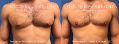Gynecomastia Before & After Gallery - Patient 264095 - Image 1