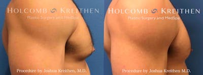 Gynecomastia Before & After Gallery - Patient 264095 - Image 2