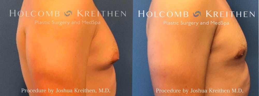 Gynecomastia Before & After Gallery - Patient 149945 - Image 1