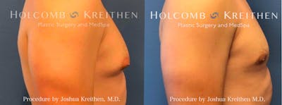 Gynecomastia Before & After Gallery - Patient 149945 - Image 1