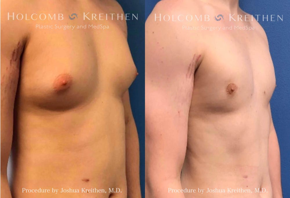 Gynecomastia Before & After Gallery - Patient 294758 - Image 2