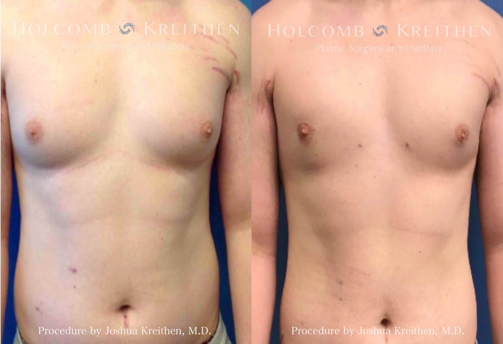 gynecomastia