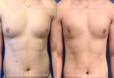 Gynecomastia Before & After Gallery - Patient 294758 - Image 1