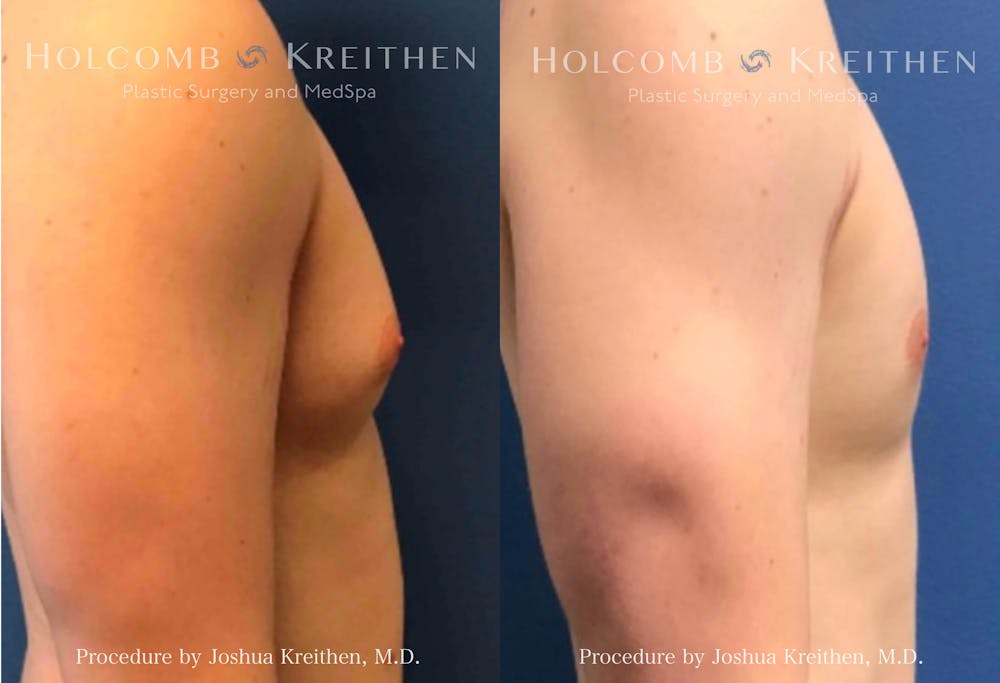 Gynecomastia Before & After Gallery - Patient 294758 - Image 3