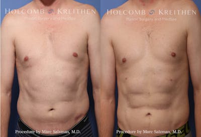 Liposuction Before & After Gallery - Patient 167439 - Image 1