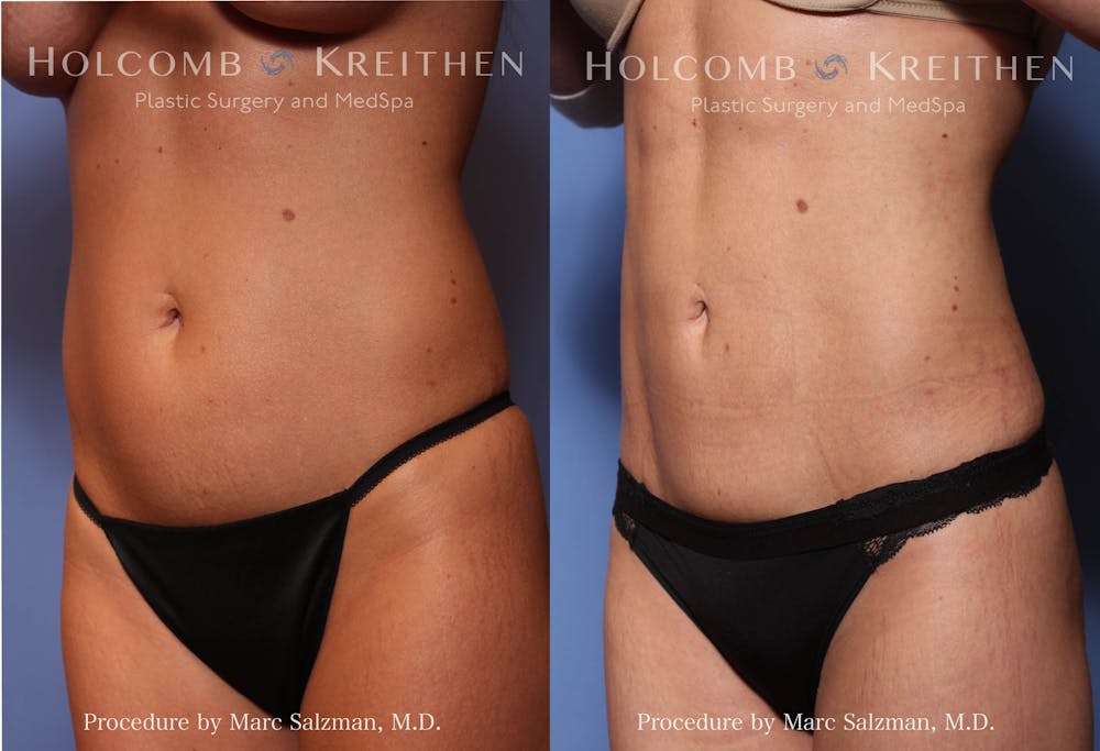 Liposuction