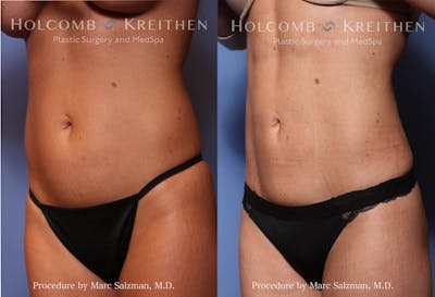 Liposuction Before & After Gallery - Patient 380471 - Image 1