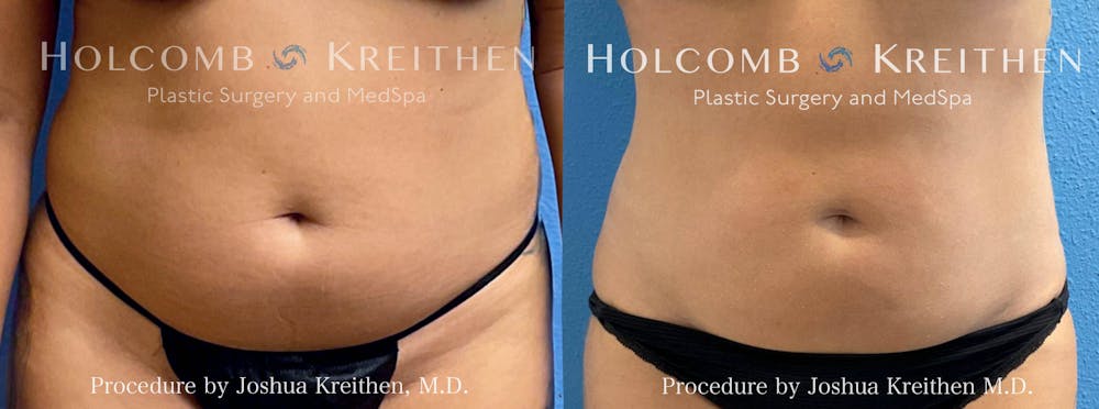 Liposuction Before & After Gallery - Patient 242346 - Image 1
